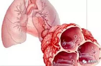 巨型肺大泡容易并发自发性气胸