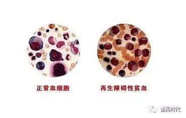 再生障碍性贫血症同中医虚劳血虚