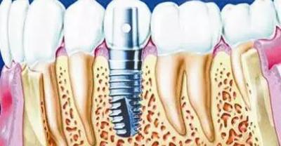 种植牙后可以饮食吗？种植牙愈合快吗？